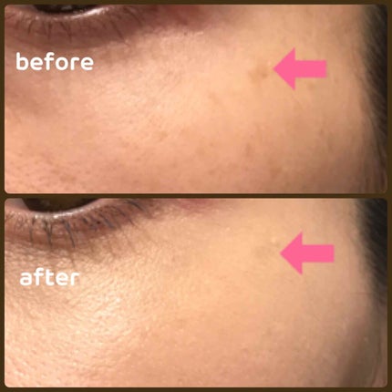 【旧】ディオールスキン フォーエヴァー スキン コレクト コンシーラー/Dior/リキッドコンシーラーを使ったクチコミ(4枚目)