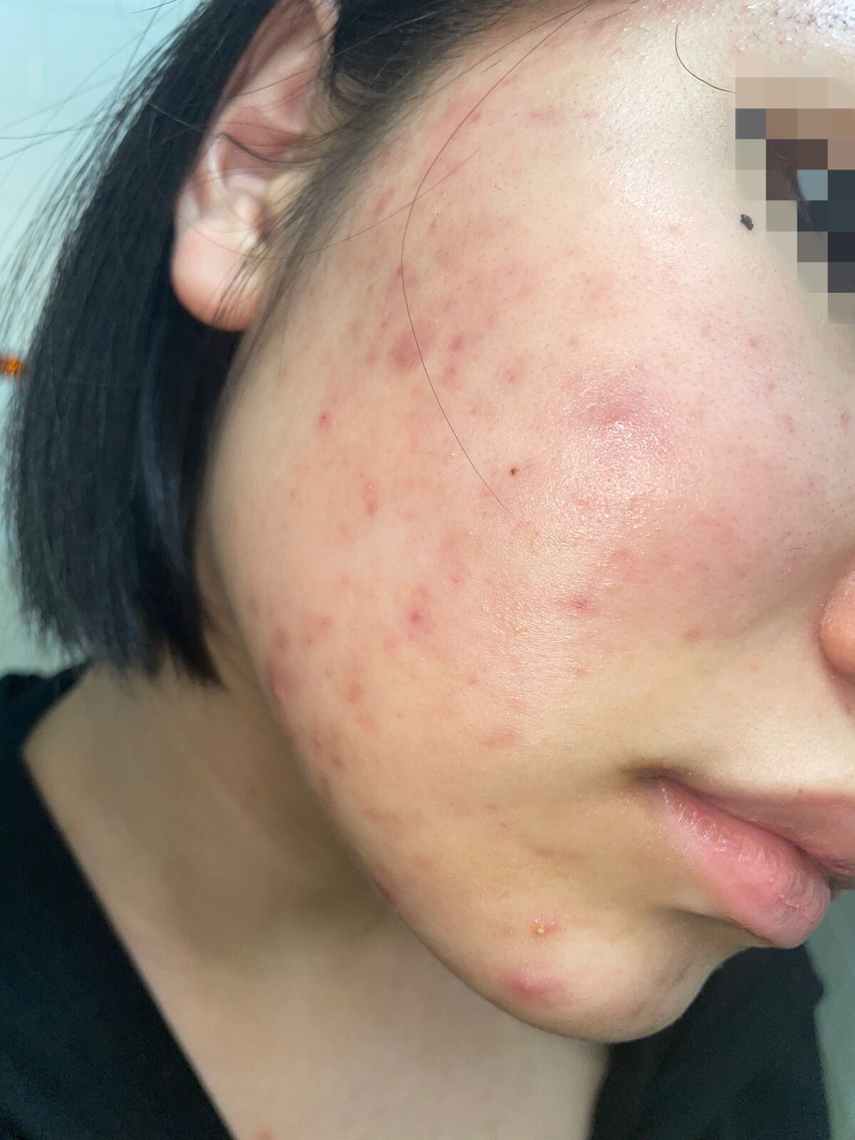 ペアアクネクリームW(医薬品)/ペア/その他を使ったクチコミ（3枚目）