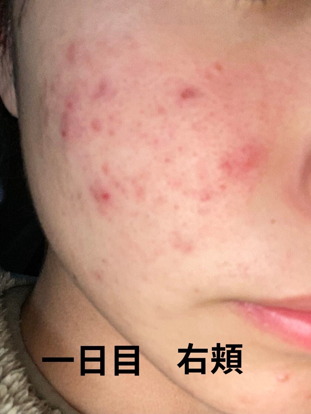 じぇーけー on LIPS 「私は中学2年生の始め頃からニキビが増え始めて、気になって潰した..」(2枚目)