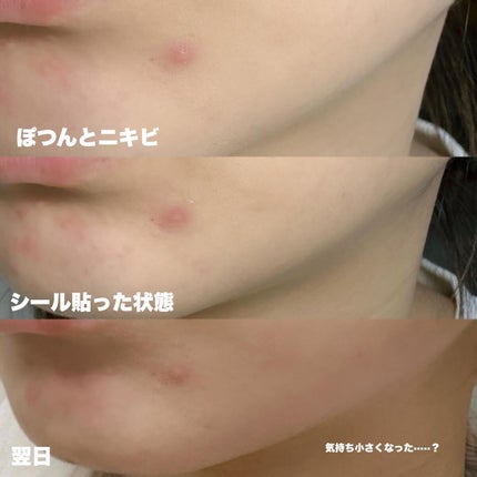 ごめんね素肌 キニナルマスク/クリアターン/シートマスク・パックを使ったクチコミ(5枚目)