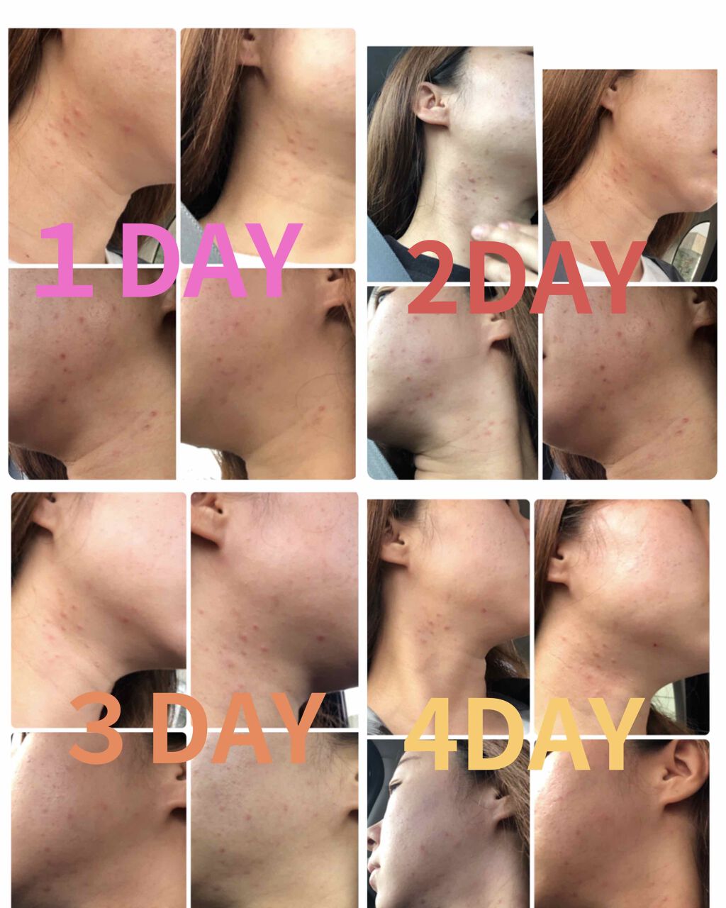 ペアアクネクリームW(医薬品)/ペア/その他を使ったクチコミ（1枚目）