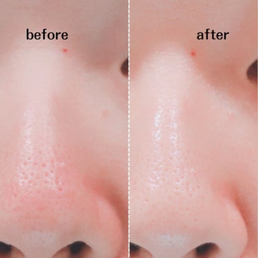 薬用ふわふわな泡洗顔/メンソレータム アクネス/泡洗顔を使ったクチコミ（4枚目）