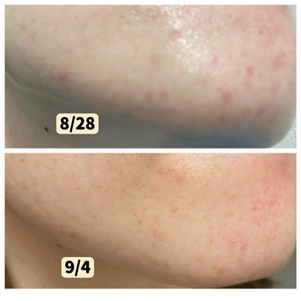 センテラ アンプル/SKIN1004/美容液を使ったクチコミ(4枚目)