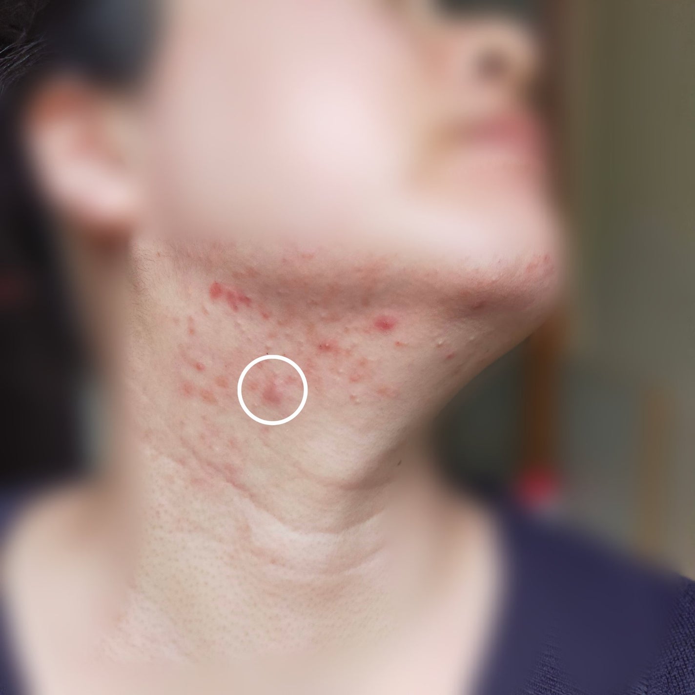 敏感肌な研究者💊あすか💊 on LIPS 「今回は首のニキビを治す最終段階で出来たニキビのそっくりさん(極..」(4枚目)