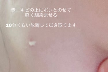 De La Cruz Acne treatmentのクチコミ「ニキビ用に買ったクリームです。
硫黄が10%配合しているので香りはまさに硫黄の香りそのまま。
.....」（3枚目）