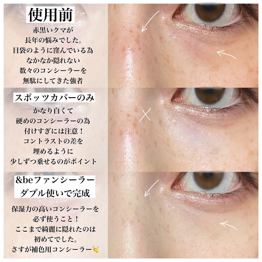 SHISEIDO・＆beのコンシーラーを使った口コミ -【こんなにクマが