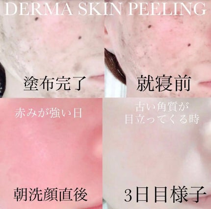 ダーマスキンピーリング/BQCELL/その他キットセットを使ったクチコミ(4枚目)