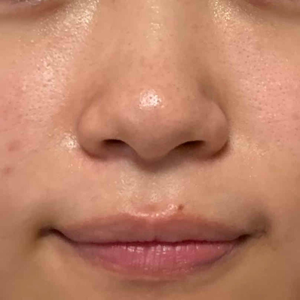 万年ニキビ肌 on LIPS 「9/25もう9月も終わりって早すぎ〜〜最近新しいニキビもほとん..」(3枚目)