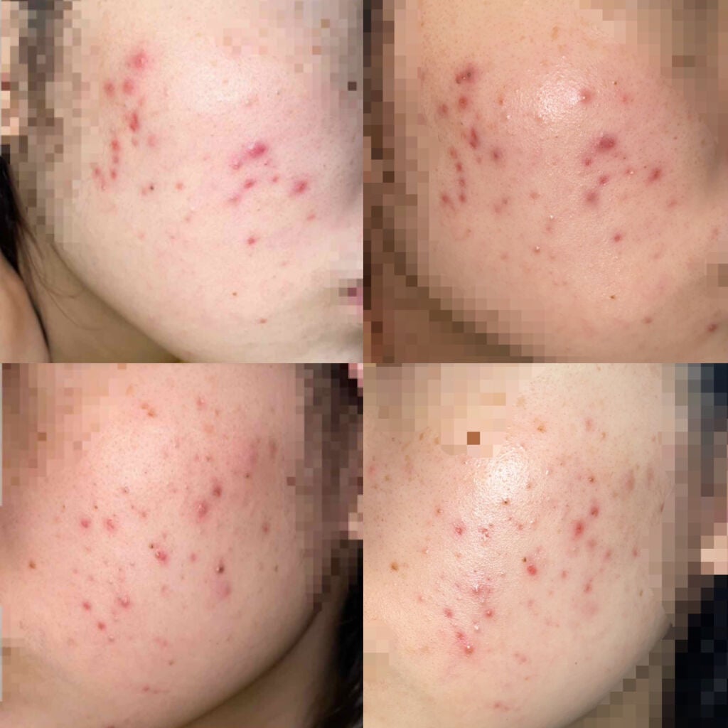 オキシドール(医薬品)/日本薬局方/その他を使ったクチコミ(2枚目)