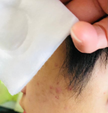 アキュネ 薬用ふきとりローションT/アキュネ/拭き取り化粧水を使ったクチコミ(5枚目)