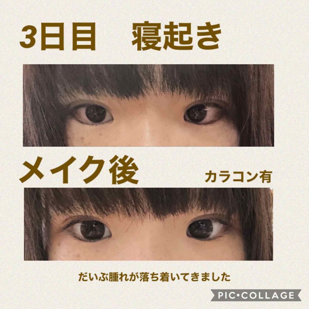 ぬこた on LIPS 「二重整形3日目。枕低くしたせいか寝起き瞼が重い…。と思って鏡見..」(2枚目)