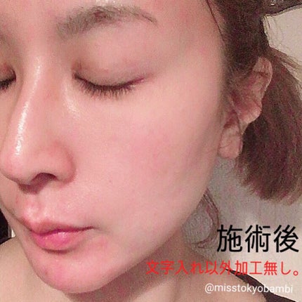 白ゆり@美容ブロガー on LIPS 「湘南美容外科でダーマペン4を受けてきました。୨୧┈┈┈┈┈..」(7枚目)