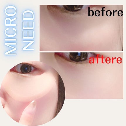 MICRO NEED ヒアルロン酸 セラムパッチ/bijoːu(ビジュー)MICRO NEED/シートマスク・パックを使ったクチコミ(7枚目)