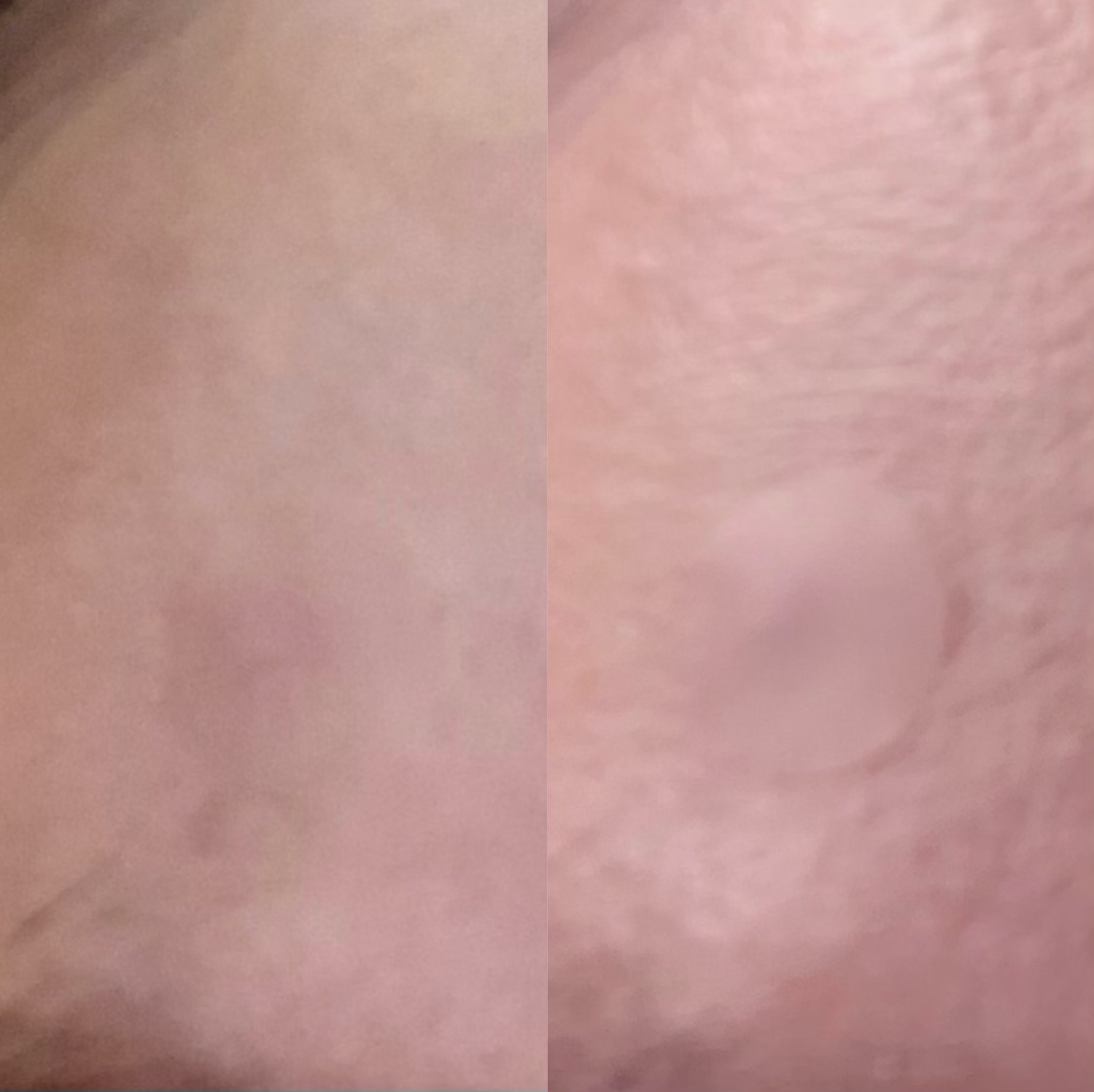 A-zero Shot Trouble Dressing Spot Patch/MEDIHEAL/シートマスク・パックを使ったクチコミ（2枚目）