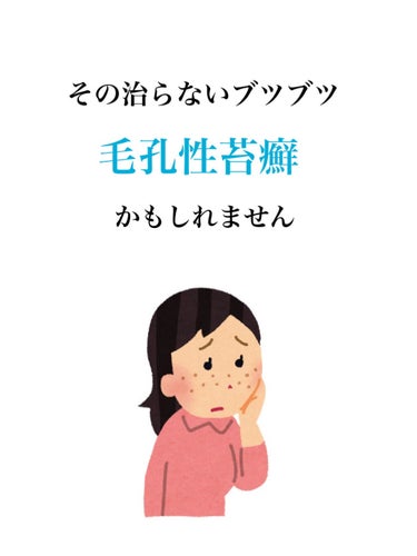 こんにちは ンゴです🐣
今回は私の頬や二の腕にあるブツブツ
「毛孔性苔癬」のお話を改めてしたいと思います。

この投稿を見てくださった方の中に
「よく見るニキビ顔とは違うのに顔がブツブツしていて治らない