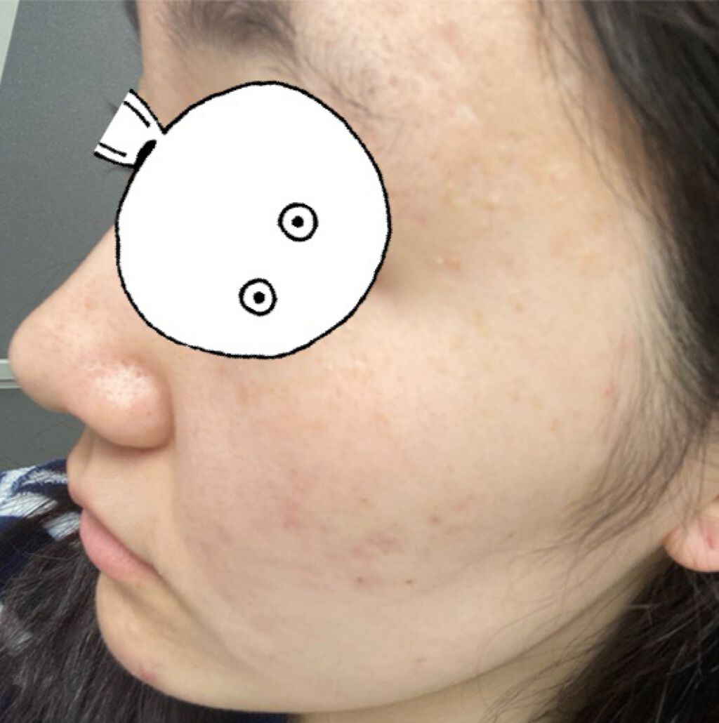 りんた on LIPS 「たくさん見ていただいて、ありがとうございます!私の肌の変化につ..」(3枚目)