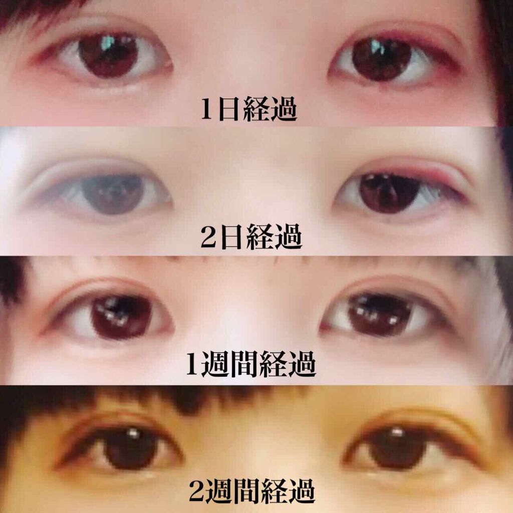 ゆず汰 on LIPS 「二重整形(埋没法)から1ヶ月以上経ちました!ダウンタイムの様子..」(2枚目)