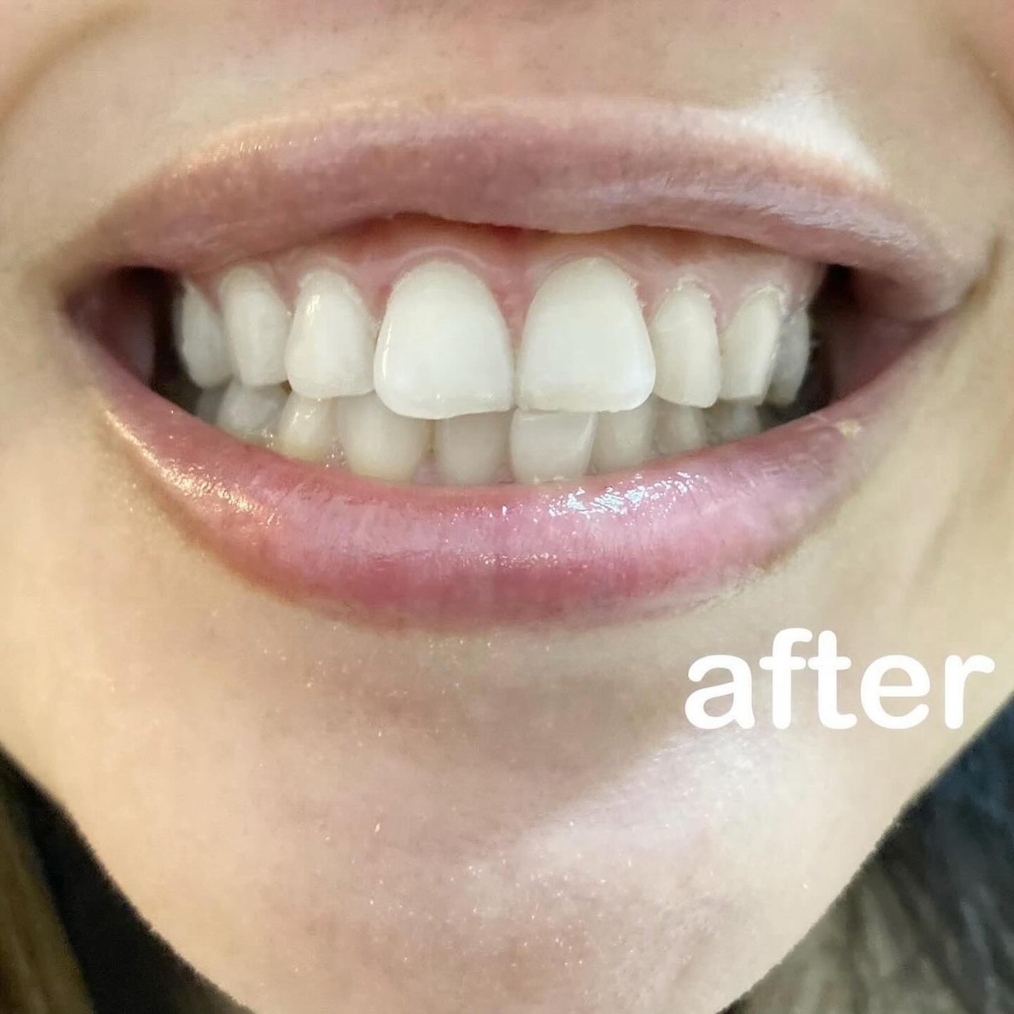 DENTA ONE/シーヴァ/その他を使ったクチコミ(5枚目)