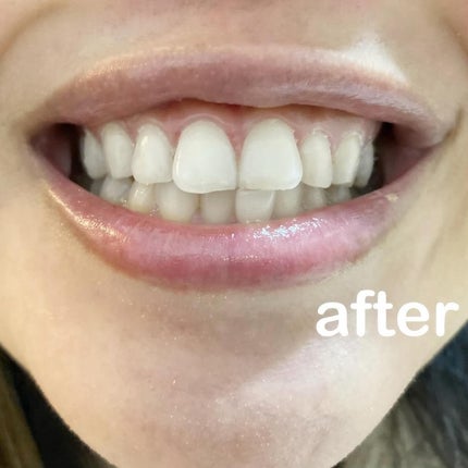 DENTA ONE/シーヴァ/その他を使ったクチコミ(5枚目)