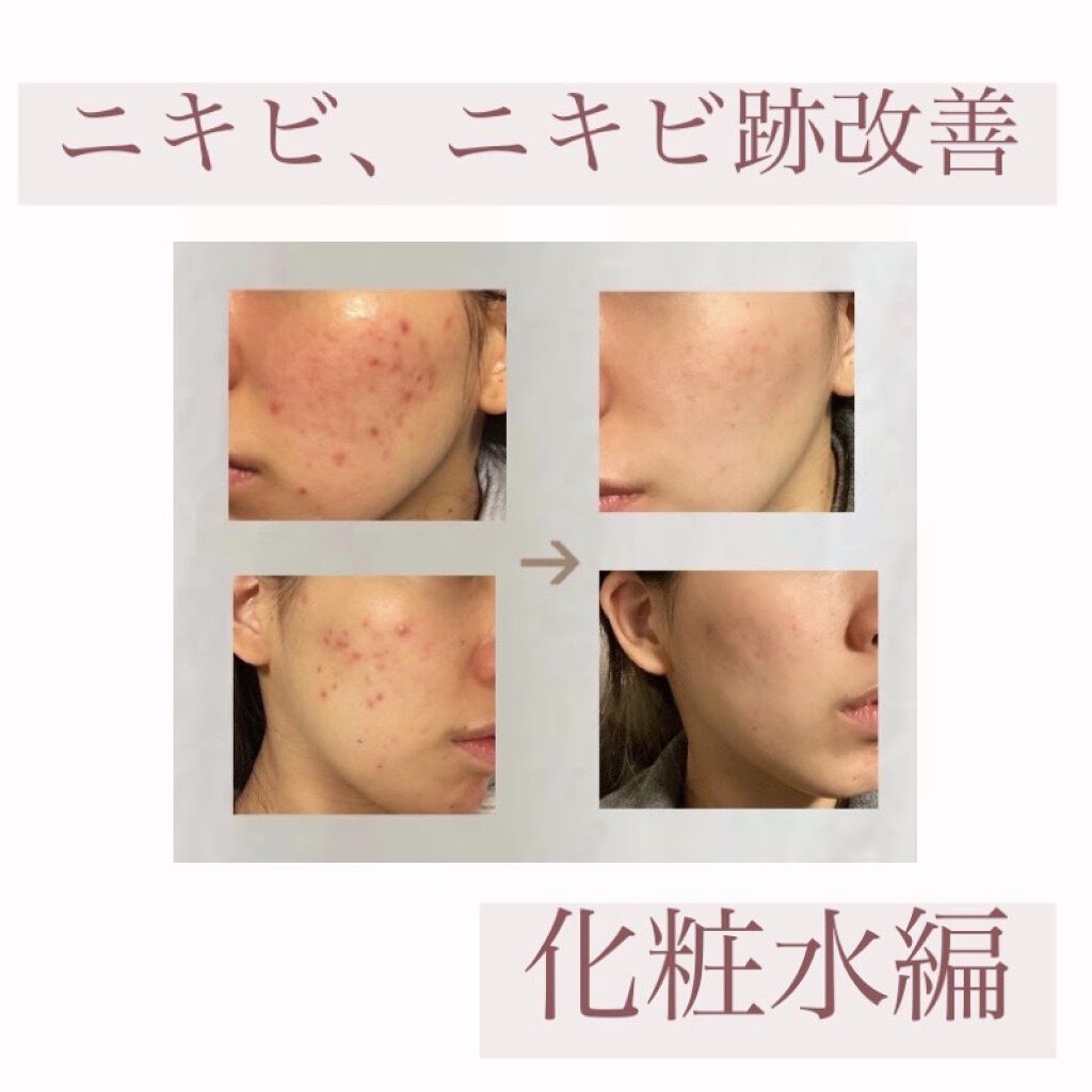 モイスチャライジングローション エトヴォスを使った口コミ リピ買い5回以上 ニキビ改善中に By Yuyu フォロバ強化中 混合肌 代後半 Lips