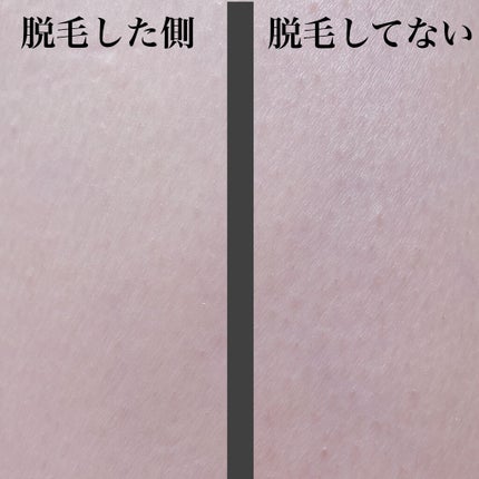 サファイアIPL脱毛器 /yete/家庭用脱毛器を使ったクチコミ(2枚目)