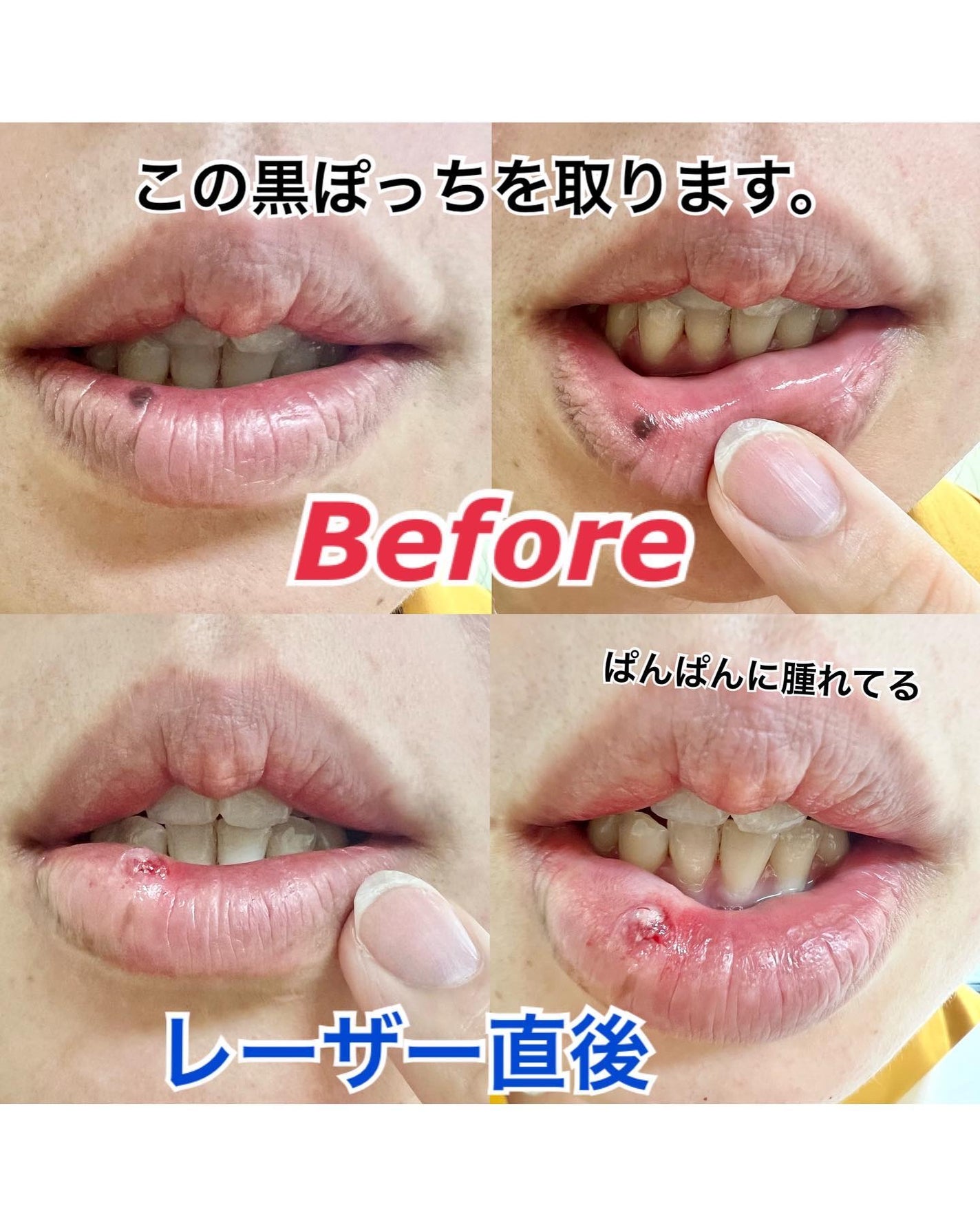 のんたん旅うさぎ on LIPS 「★唇🫦のホクロを取ったハナシ★最近、yamate_hifuka..」(1枚目)