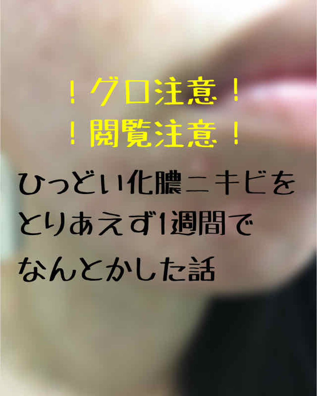 クロマイ-P軟膏AS(医薬品)/クロマイ/その他を使ったクチコミ（1枚目）