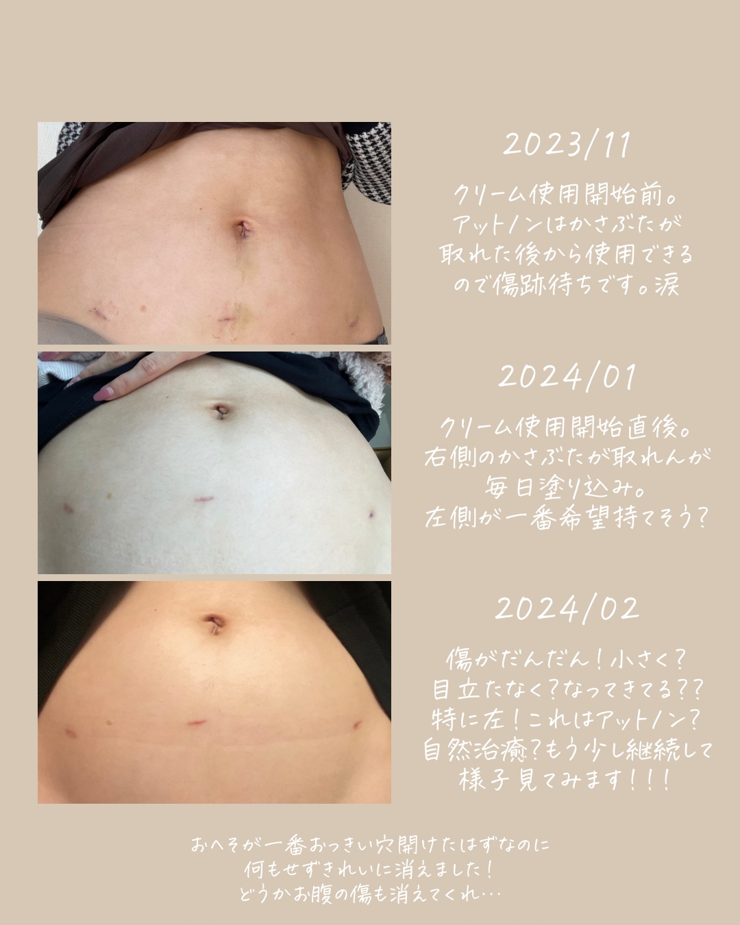 アットノンEX クリーム(医薬品)/アットノン/その他を使ったクチコミ（3枚目）