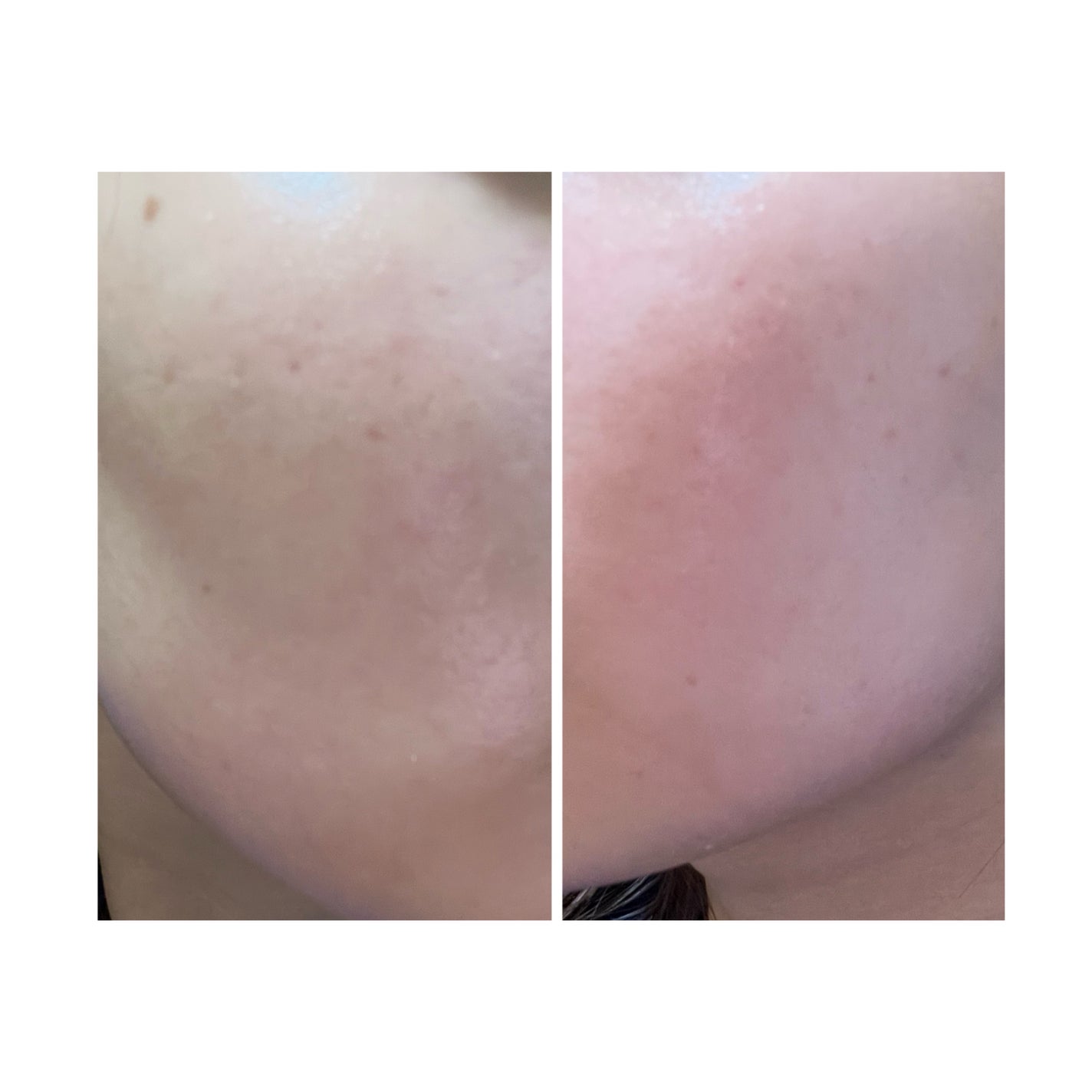 ぽむ on LIPS 「2023.9.13皮膚科に受診 エピデュオとヘパリン処方1枚目..」(1枚目)