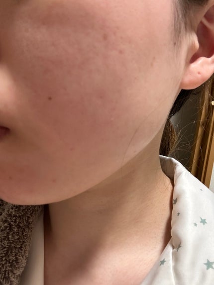 薬用しみ集中対策 プレミアム美容液/メラノCC/美容液を使ったクチコミ(4枚目)