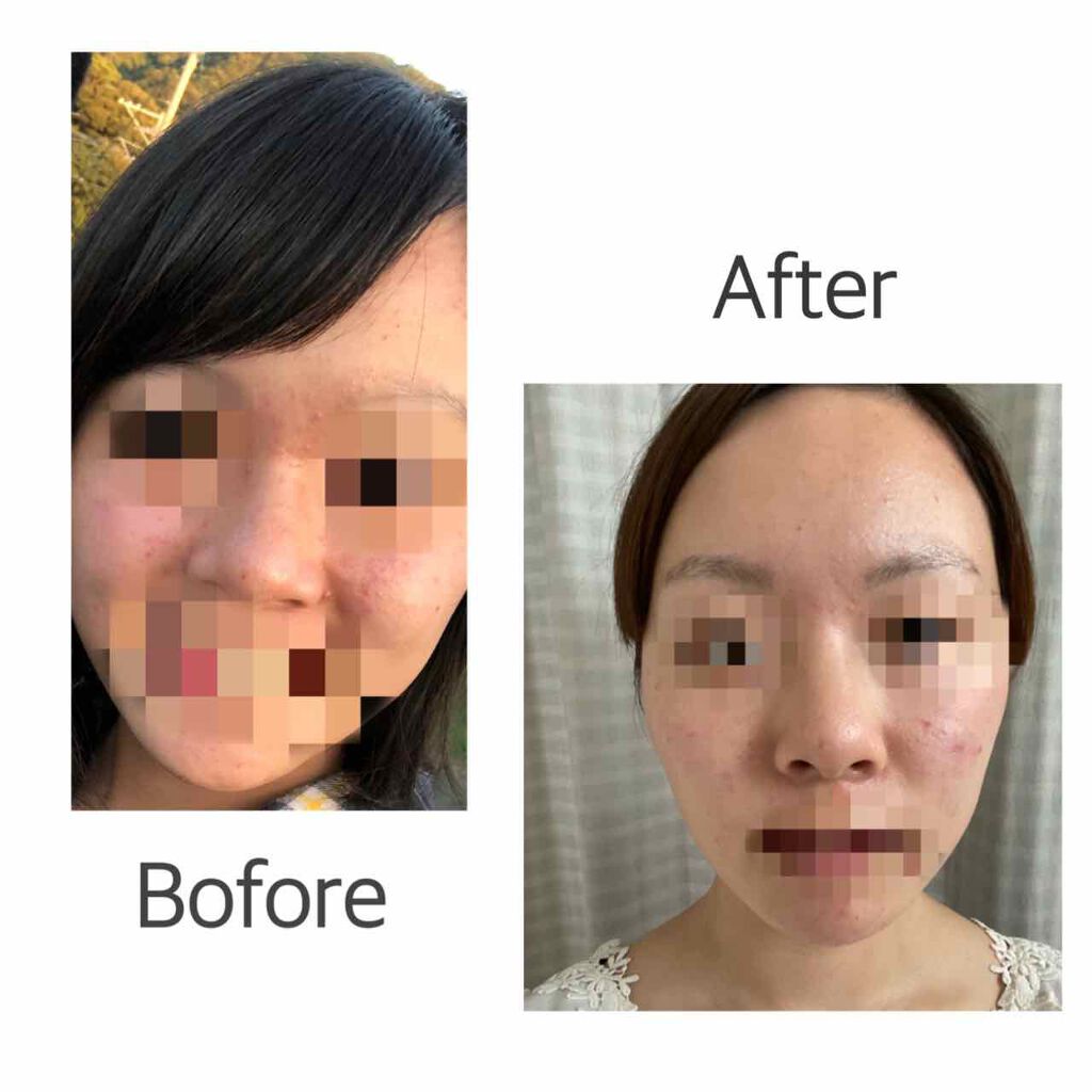 潤浸保湿 化粧水 II しっとり/キュレル/化粧水を使ったクチコミ(3枚目)