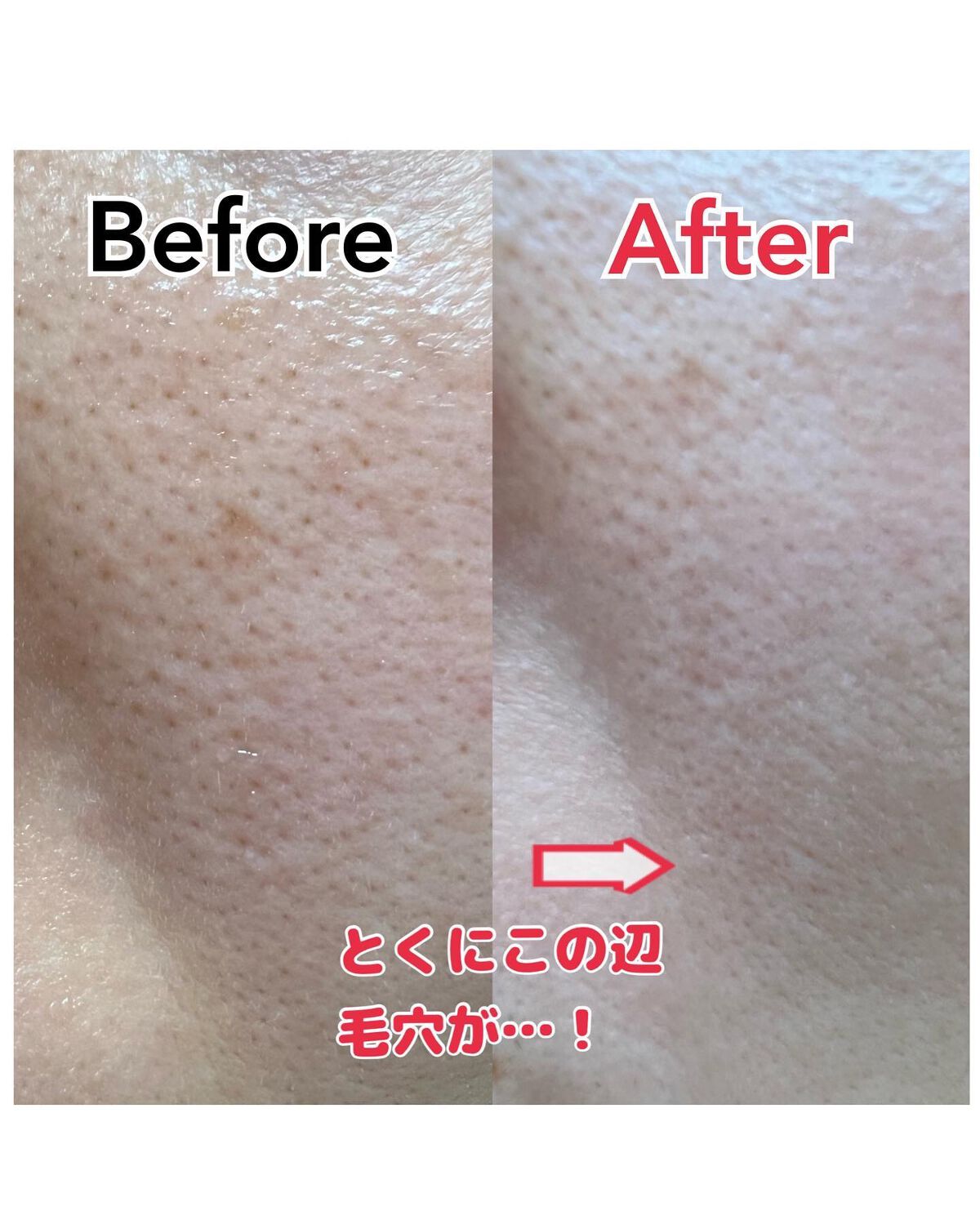 ゼロ毛穴1DAYセラム/MEDICUBE/美容液を使ったクチコミ(3枚目)