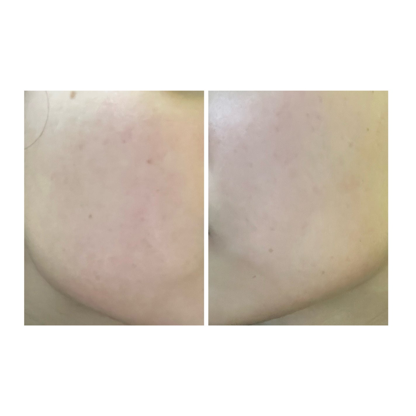 ぽむ on LIPS 「2023.9.13皮膚科に受診 エピデュオとヘパリン処方1枚目..」(3枚目)