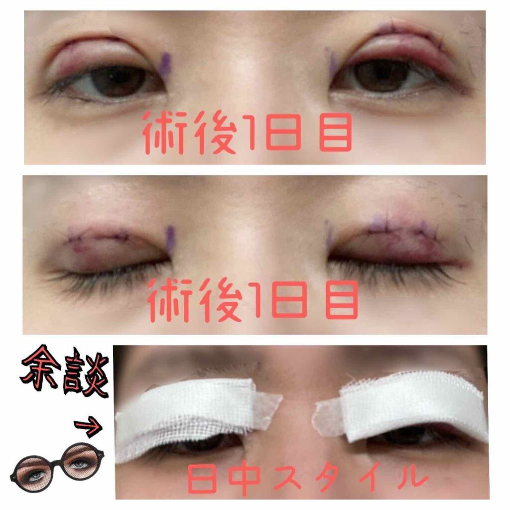 fantastic_blush_7x5 on LIPS 「こんばんは。二重手術(小切開法・部分切開法)術後1日目です。約..」(3枚目)