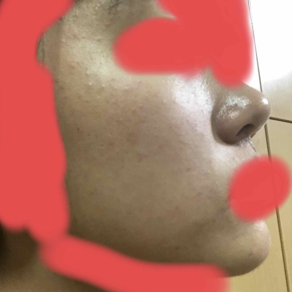 ノブ Ａ アクネソープ/NOV/洗顔石鹸を使ったクチコミ（3枚目）