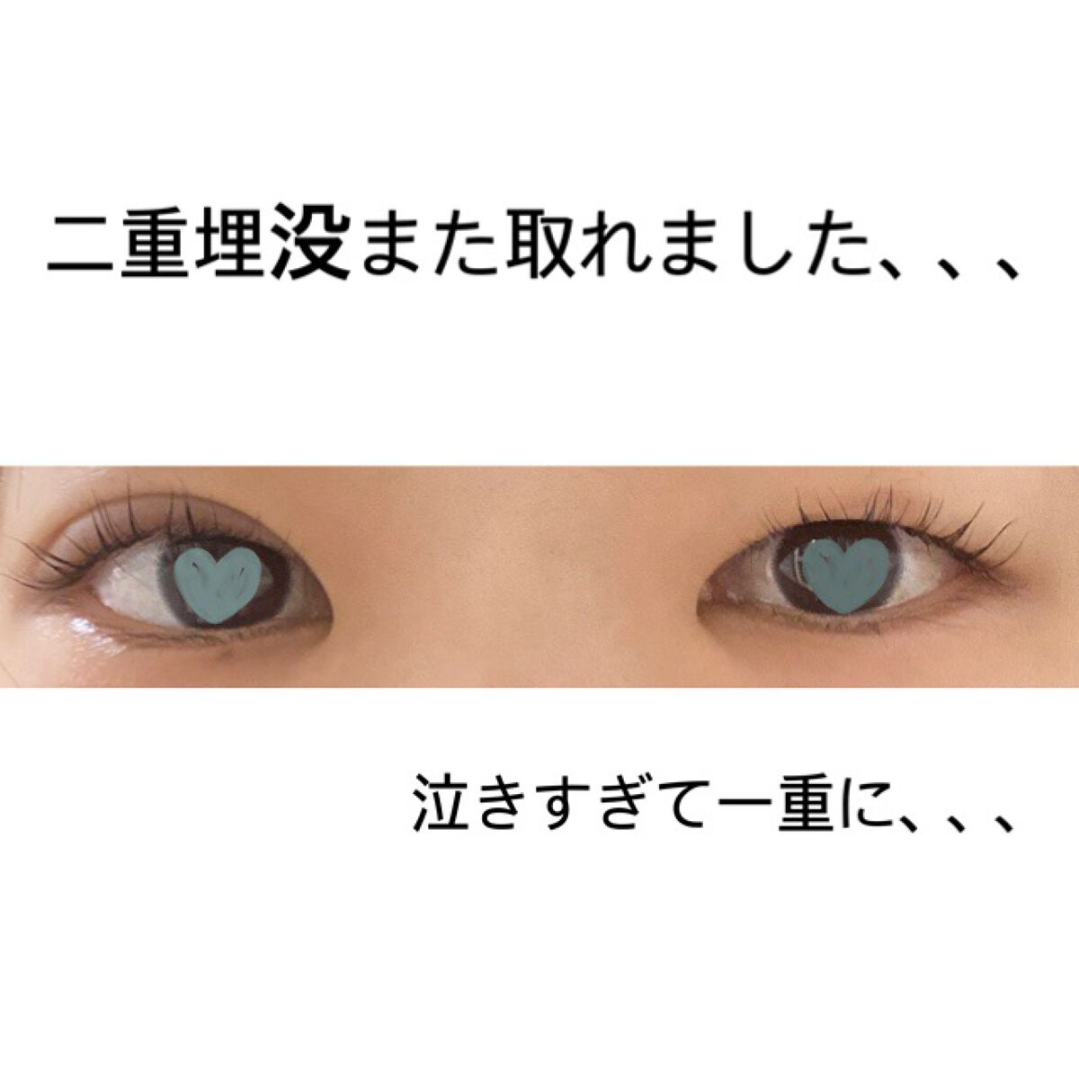 二重整形/その他を使ったクチコミ（1枚目）