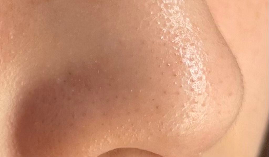 ゆゆ on LIPS 「みなさん、助けてください!!ずっと前からこの黒ずみが気になって..」(3枚目)