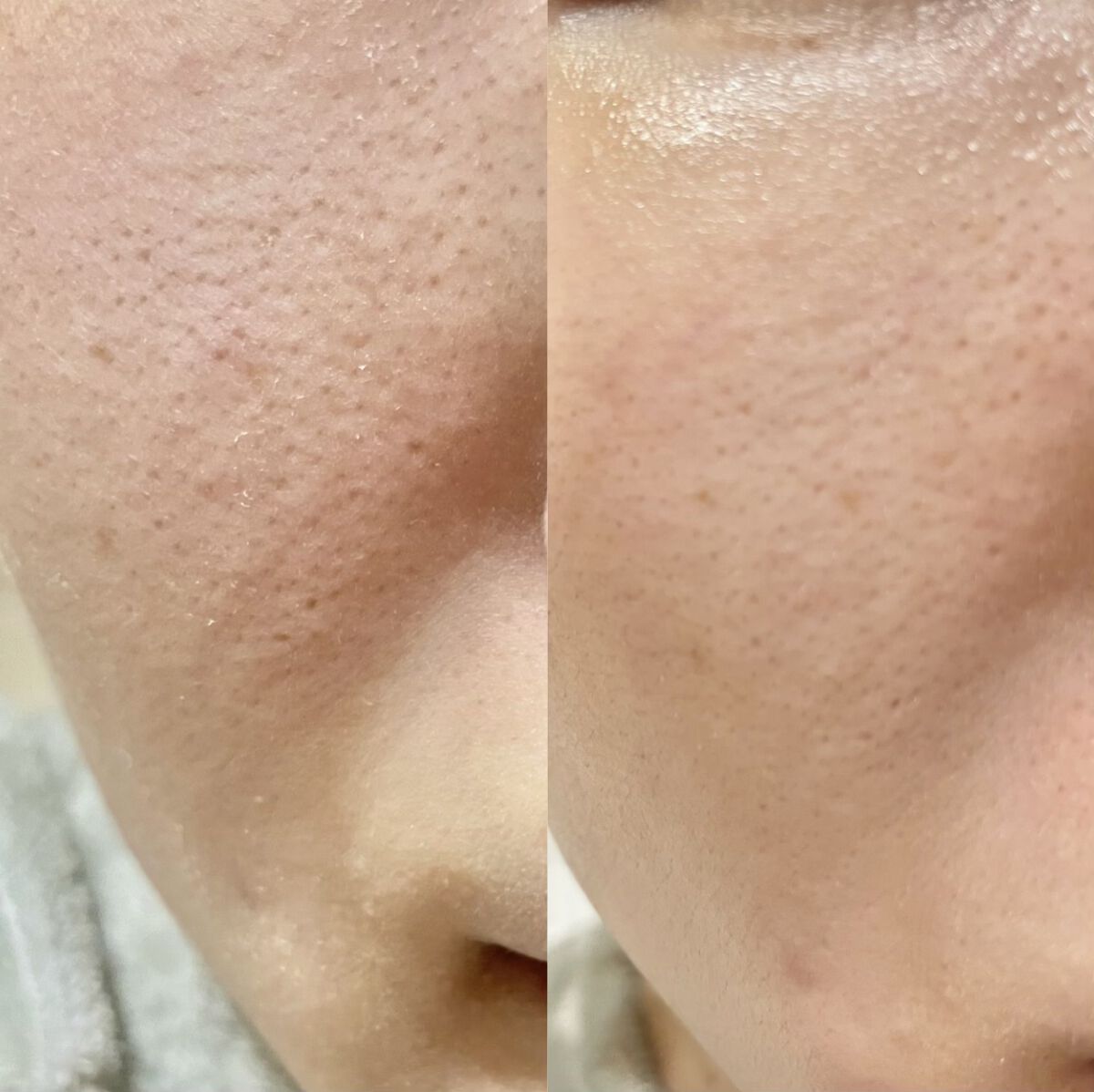 シカレチA エッセンス0.1/VT/美容液を使ったクチコミ（3枚目）