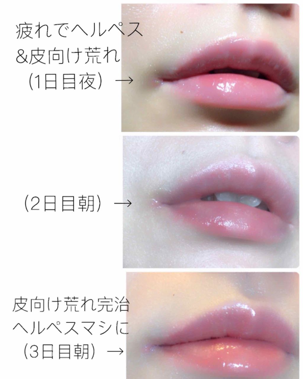 モアリップ N (医薬品)/資生堂薬品/その他を使ったクチコミ(3枚目)