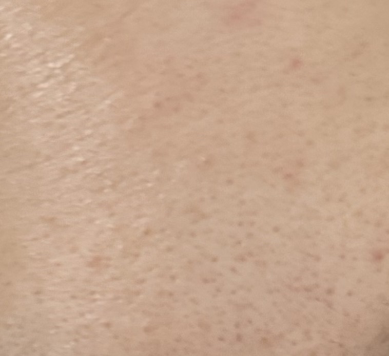 ノブ Ａ アクネソープ/NOV/洗顔石鹸を使ったクチコミ（3枚目）