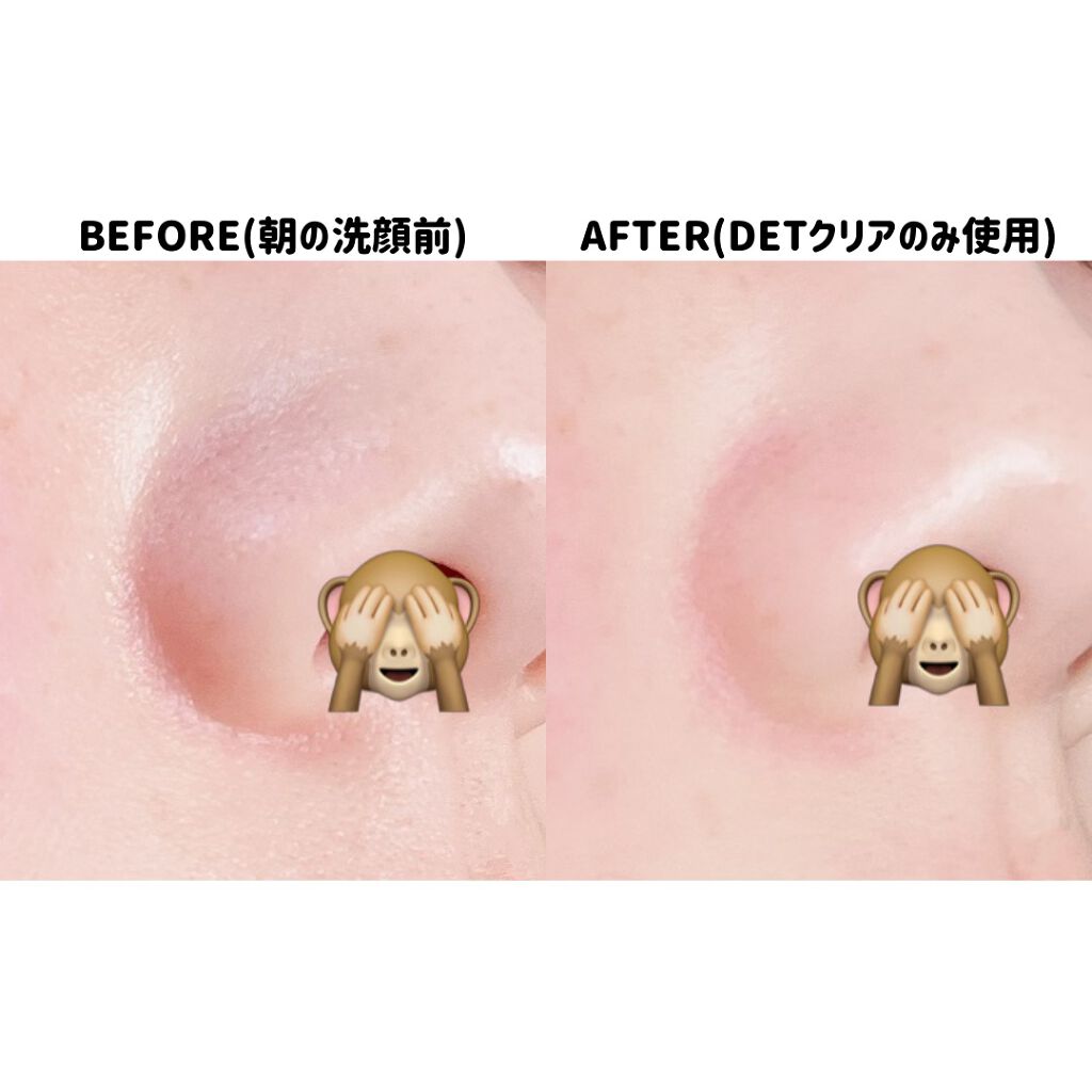 DETクリア ブライト&ピール ピーリングジェリー<炭タイプ>/Detclear/ピーリングを使ったクチコミ(4枚目)