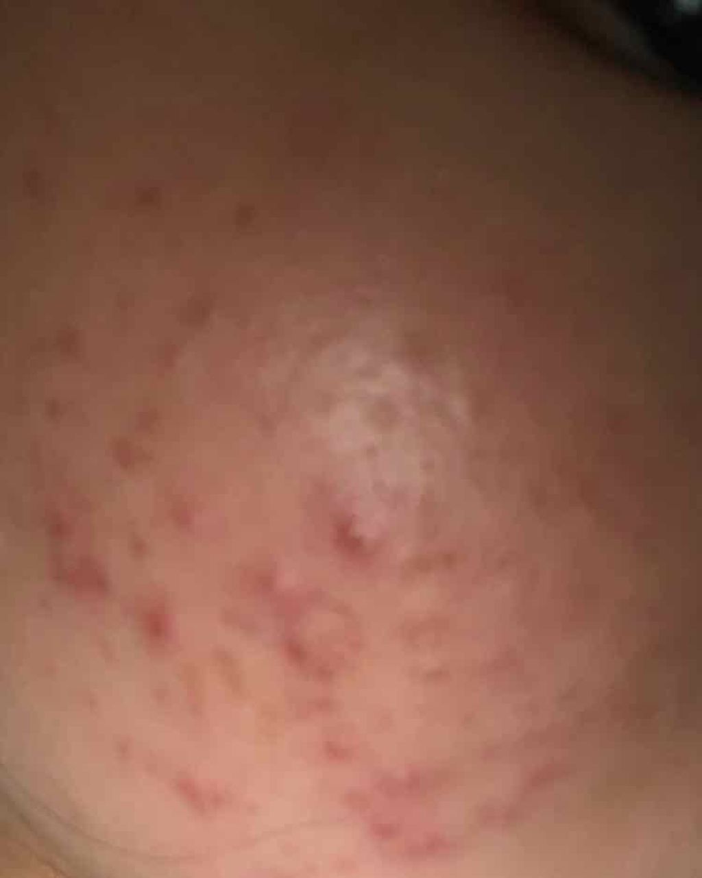 こむぎ on LIPS 「#肌荒れ#脂性肌#ニキビ2~3枚目の写真閲覧注意です!私の頬の..」(2枚目)