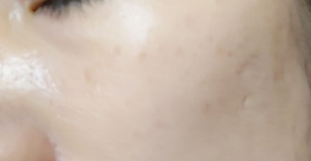 CHA on LIPS 「シミ取りレーザー8日目。右頬にあったおっきなシミがポロって取れ..」(3枚目)