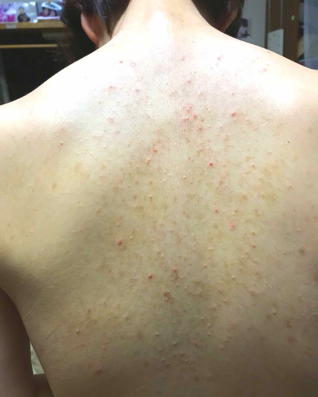 ニキビを防ぐ薬用石鹸 ForBack/ペリカン石鹸/ボディ石鹸を使ったクチコミ（3枚目）