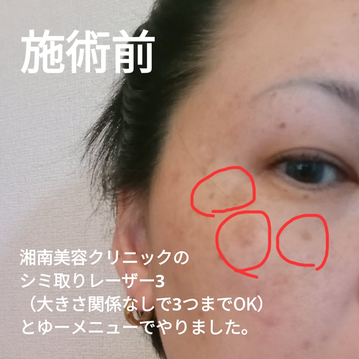 ビヨンセ奥二重向上委員長🥸LIPSパートナー🥳 on LIPS 「ついに!!この時が🤣🩷シミ取りレーザー全記録です🙌🙌🙌(五日目..」(2枚目)