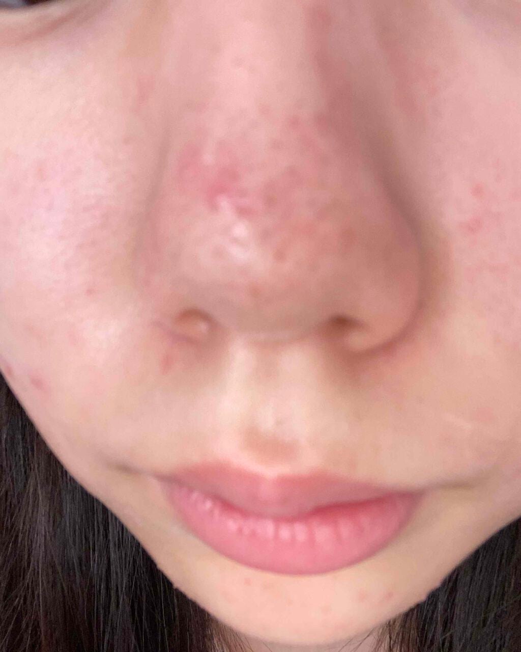 mo on LIPS 「ニキビ治りません皮膚科に行ってもダメでした色んな薬使いましたが..」(5枚目)