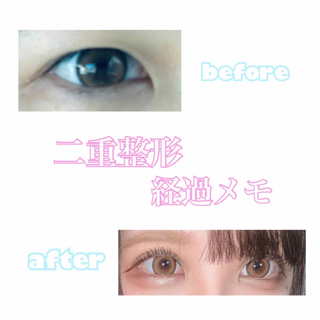 Sa on LIPS 「6月10日(水)に二重の埋没をしてきましたずっと、重たい奥2重..」(1枚目)