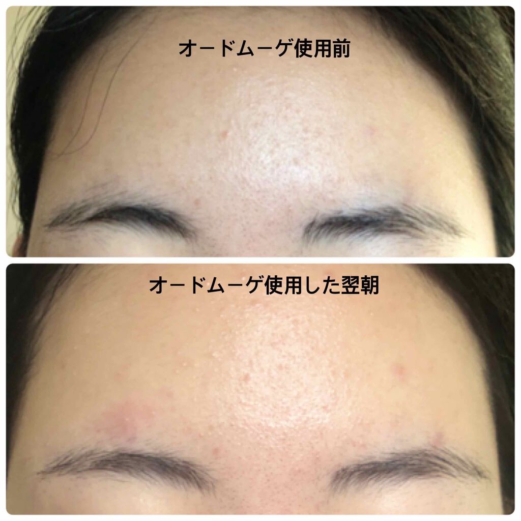 オードムーゲ 薬用ローション(ふきとり化粧水)/オードムーゲ/拭き取り化粧水を使ったクチコミ(2枚目)