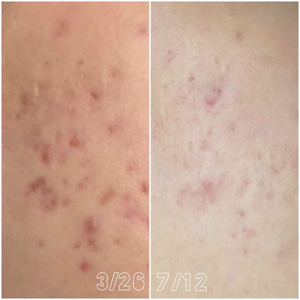 オードムーゲ 薬用ローション（ふきとり化粧水）/オードムーゲ/拭き取り化粧水を使ったクチコミ（2枚目）