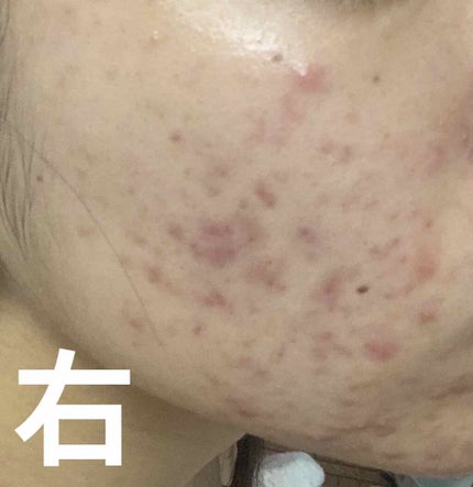 ベピオゲル/マルホ株式会社/その他を使ったクチコミ(1枚目)